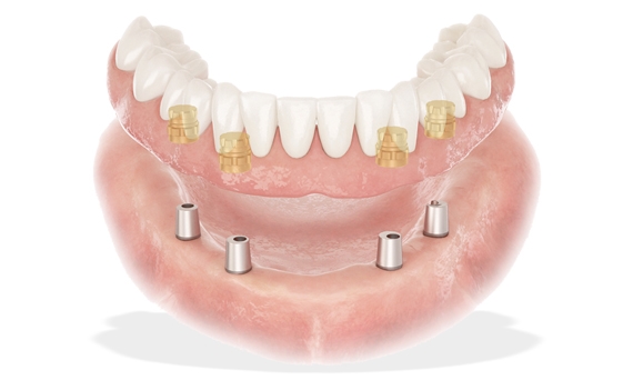 Pro3dure GR-14.1 denture: resina per basi di protesi mobili 